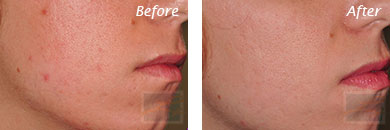 Texture, Pores & Discoloration - Before and After Case 20
