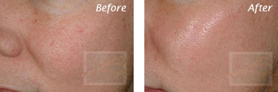 Texture, Pores & Discoloration - Before and After Case 21