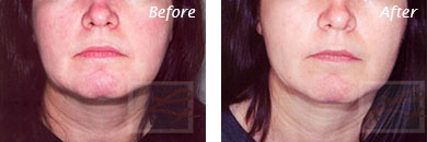 Facial Redness and Rosacea - Before and After Case 5