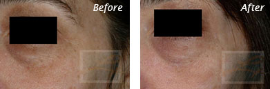 Eyes - Before and After Case 2