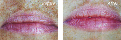 Texture, Pores & Discoloration - Before and After Case 26