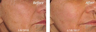Texture, Pores & Discoloration - Before and After Case 8
