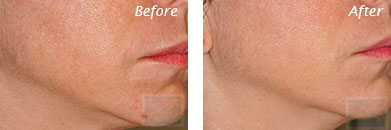 Texture, Pores & Discoloration - Before and After Case 39