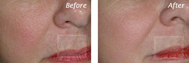 Texture, Pores & Discoloration - Before and After Case 54