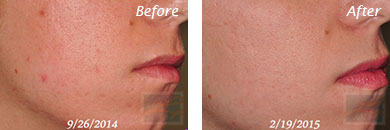 Texture, Pores & Discoloration - Before and After Case 11
