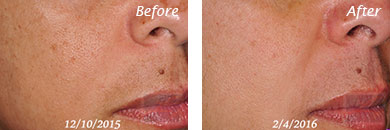 Texture, Pores & Discoloration - Before and After Case 13